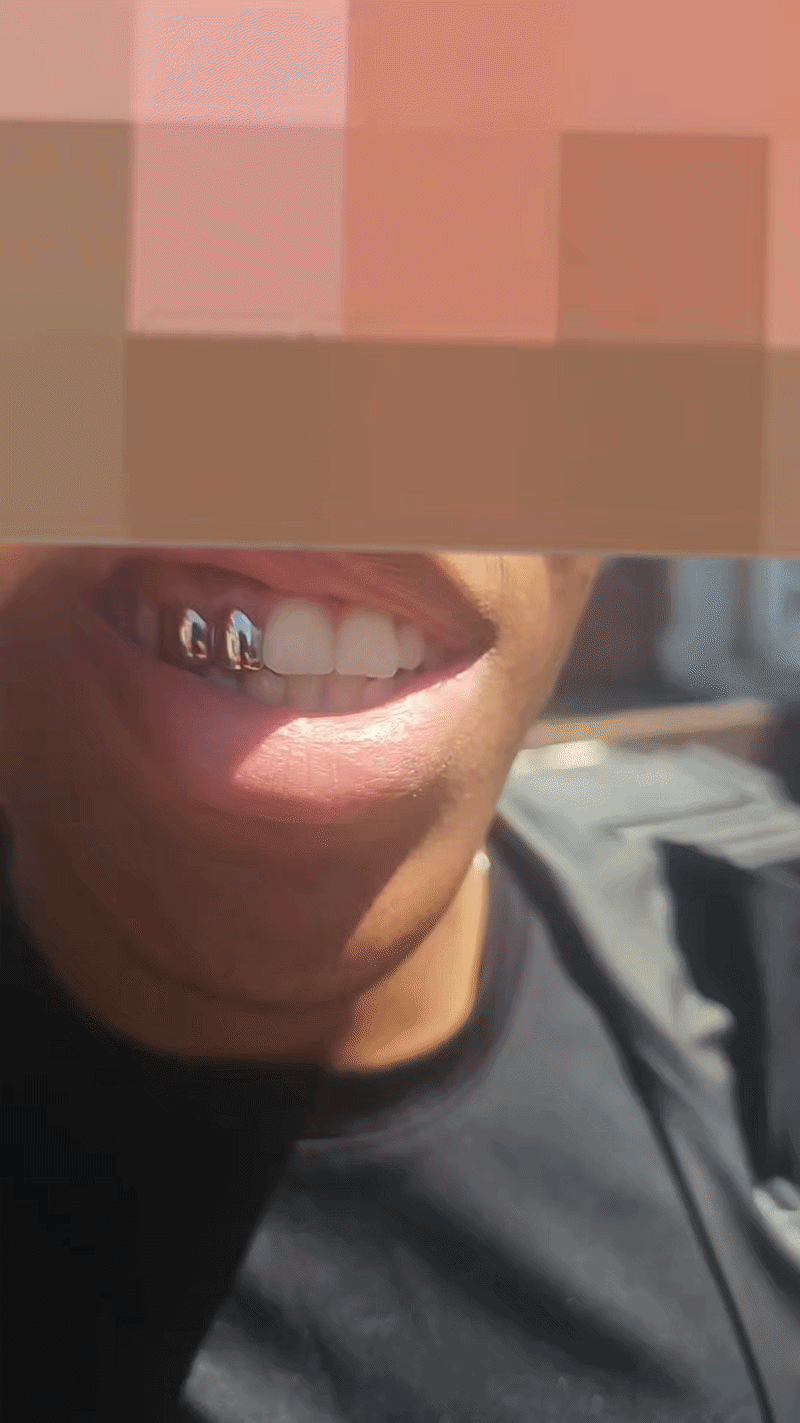 Dental silver cainine and incisor