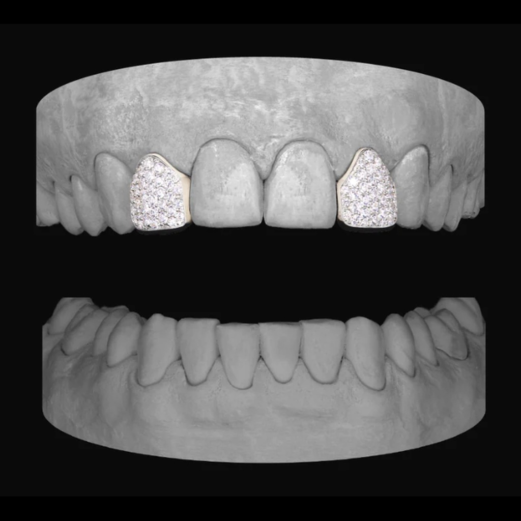 2x Diamond Lateral
