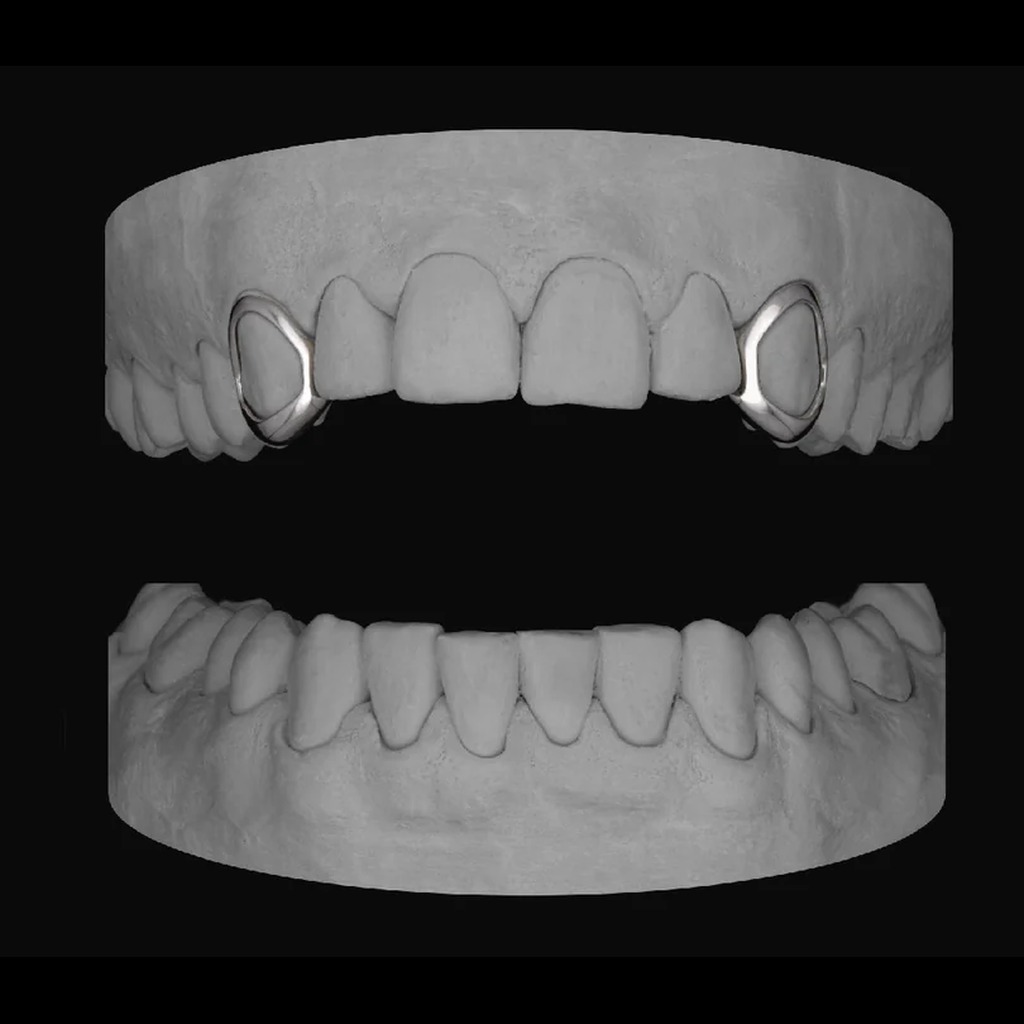2x Window Canines (Upper)