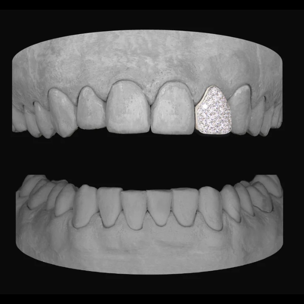 Diamond Lateral