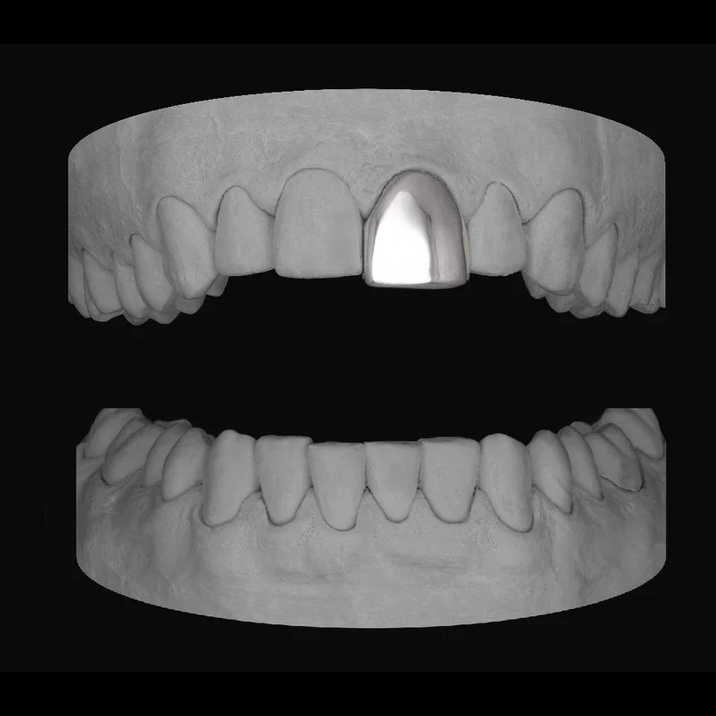 Single Front Tooth