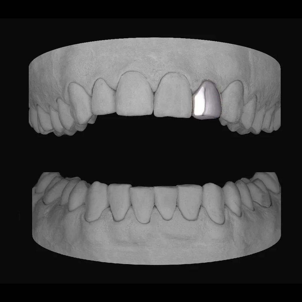 Single Lateral