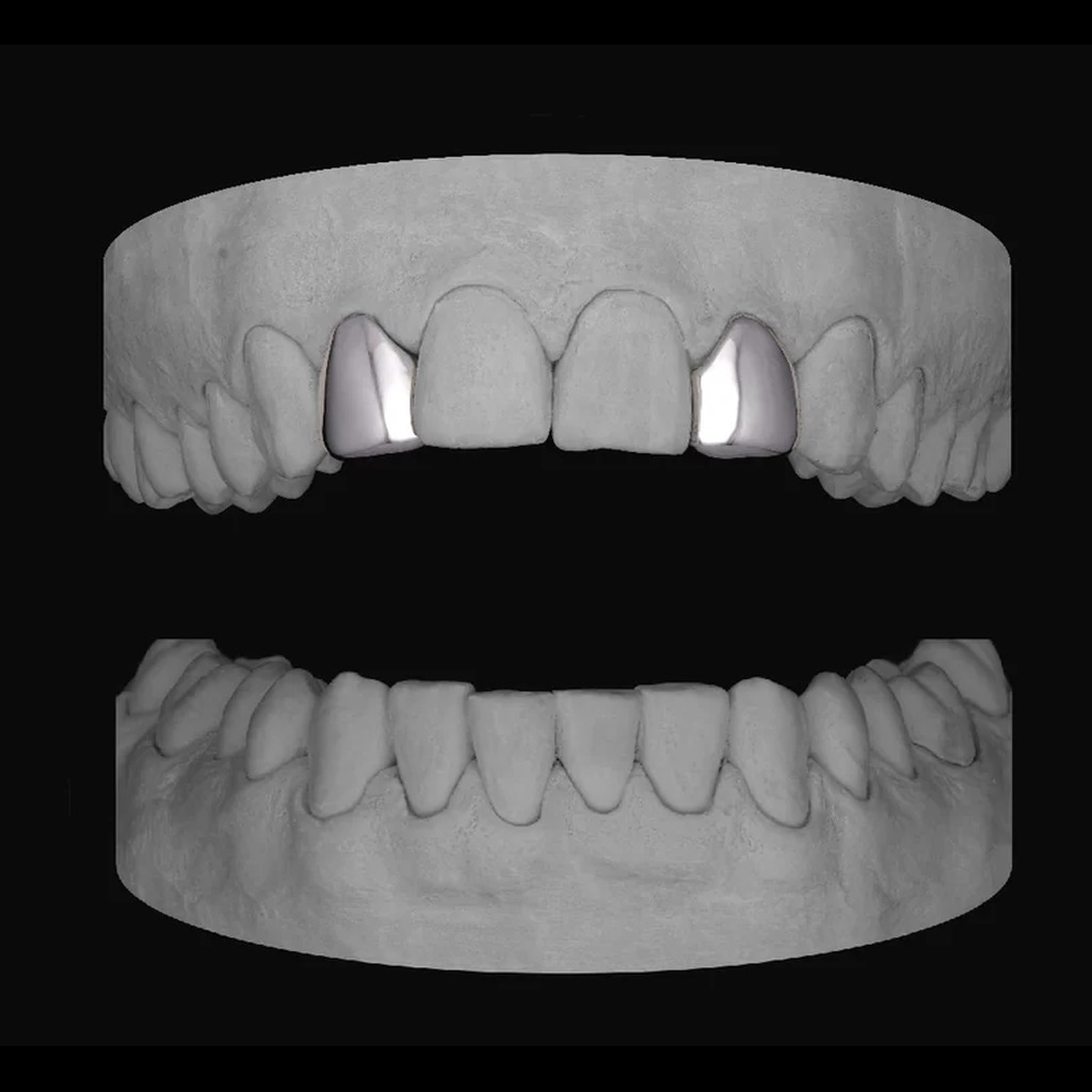 Lateral to Lateral (Upper, Both Sides)